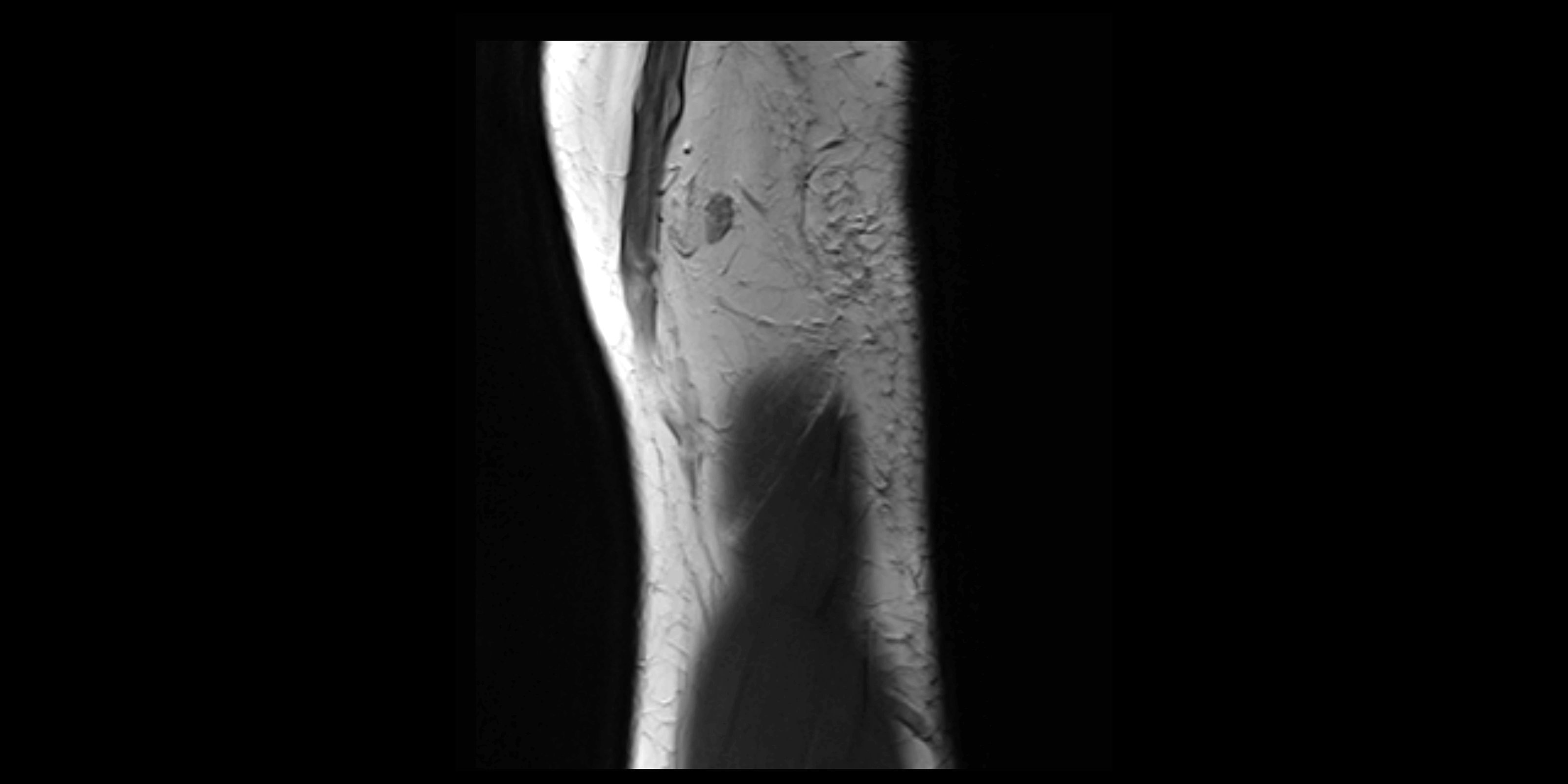 MRI elbow sagittal cross sectional anatomy 3T radiology  image-img-00001-00005.webp